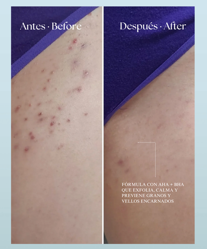 Smoothing Solution - Tratamiento Post-Depilación