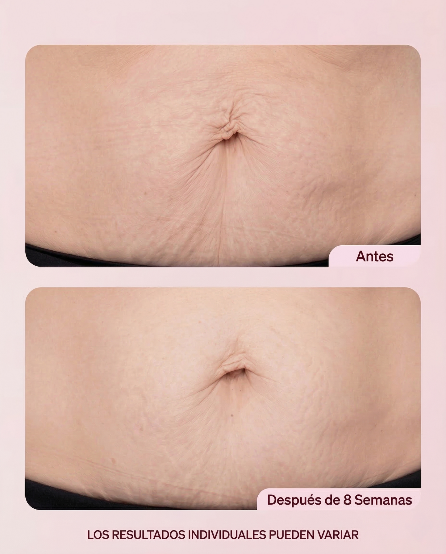 Belly Sculpt - Tratamiento Reparador Estrías y Flacidez
