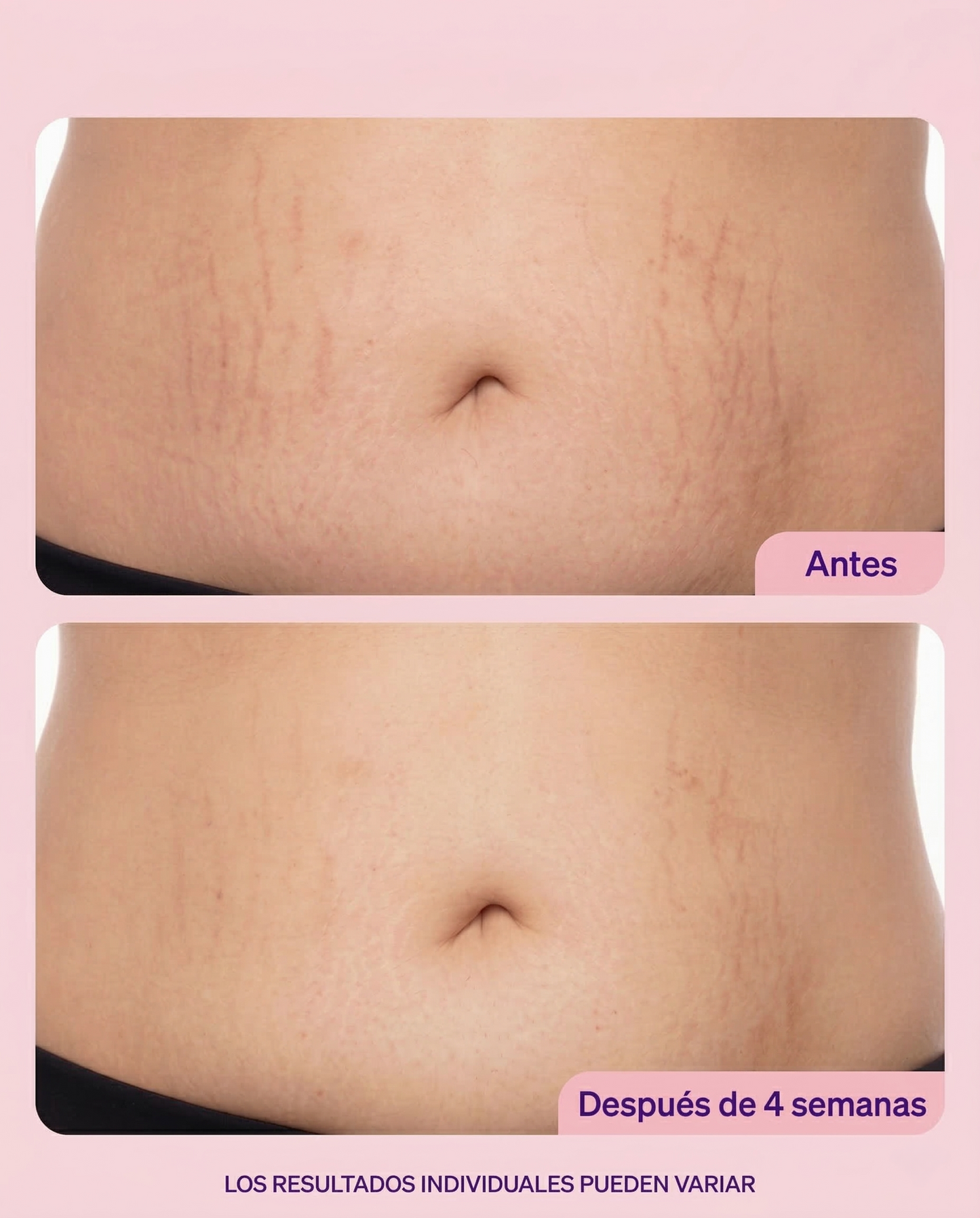 Belly Sculpt - Tratamiento Reparador Estrías y Flacidez
